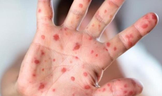 شناسایی ۷۰ نفر مبتلا به سرخک در استان هرمزگان