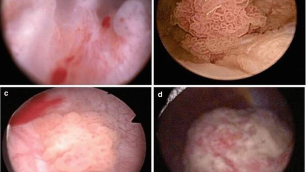 جراحی لیزری تومور مثانه در بیمارستان قشم با موفقیت انجام شد