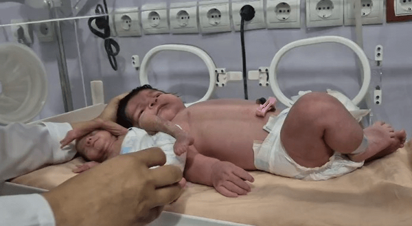 تولد دو نوزاد با اختلاف وزن ۱۱ برابری در بندرعباس